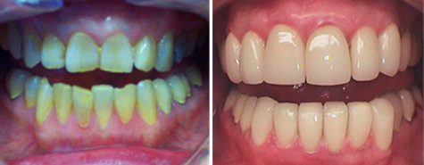 Twenty porcelain fused to metal crowns to restore and revitalize this smile.