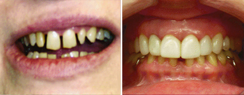 Twelve porcelain veneers to restore a smile with excessive spacing.