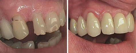 Crown and bridgework before and after