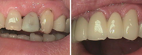 Crown and bridgework before and after