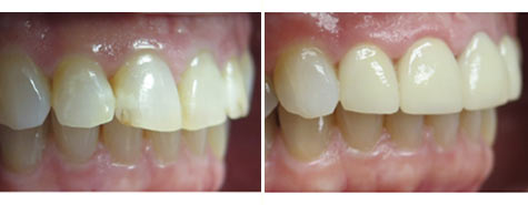 Four e.max metal free crowns