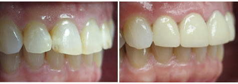 Four e.max metal free crowns