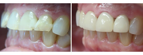 Four e.max metal free crowns