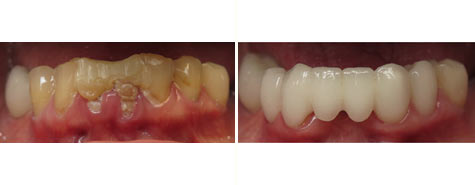 Seven decayed and damaged teeth restored with e.max metal free crowns and bridgework