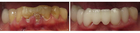 Seven decayed and damaged teeth restored with e.max metal free crowns and bridgework