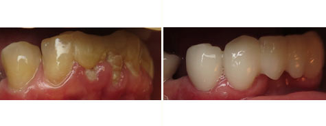 Seven decayed and damaged teeth restored with e.max metal free crowns and bridgework