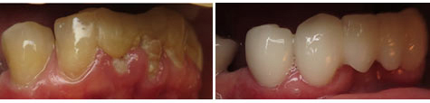 Seven decayed and damaged teeth restored with e.max metal free crowns and bridgework