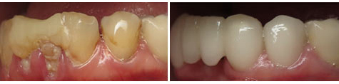 Seven decayed and damaged teeth restored with e.max metal free crowns and bridgework