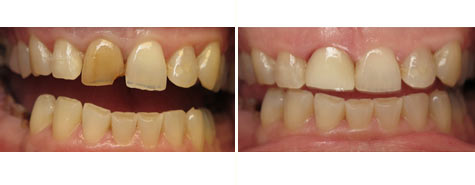 Right front tooth restored with e.max all porcelain crown