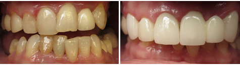 E.max crowns and bridgework