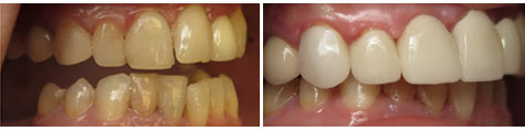 E.max crowns and bridgework