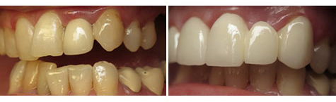 E.max crowns and bridgework