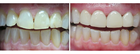 Four e.max metal free crowns