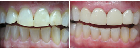 Four e.max metal free crowns